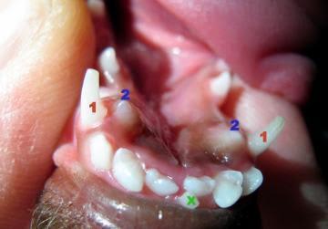 Base Narrow Canine Teeth